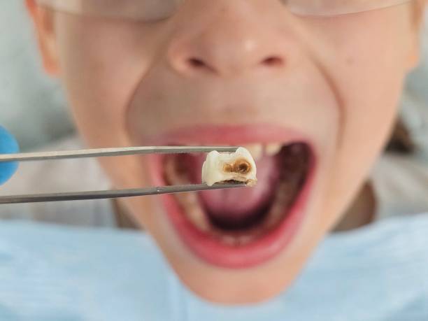 Best Emergency Dentist for Knocked-Out Tooth in Olmos Park, TX